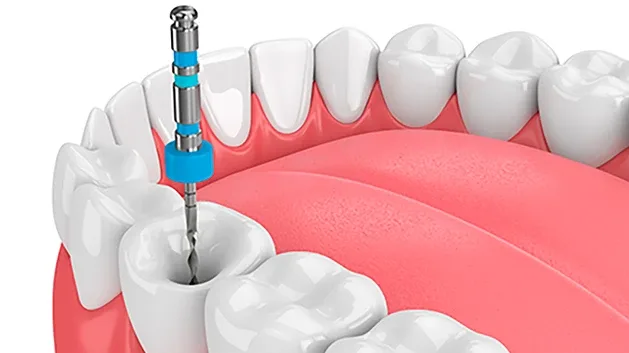 Imagem do tratamento de endodontia
