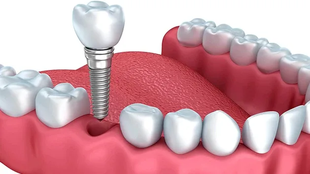 Ilustração de implante dentário posicionado na arcada
