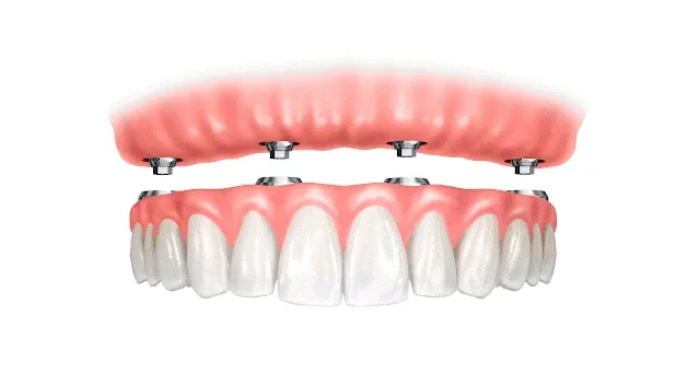 Imagem do tratamento de prótese dentária